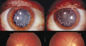 star-shaped-cataract