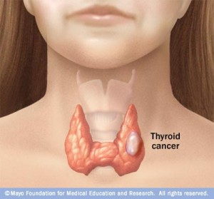 c7_thyroid_cancer